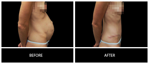 CORE Abdominoplasty Before and After